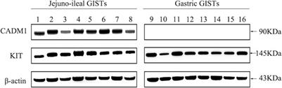 Differential Expression of CADM1 in Gastrointestinal Stromal Tumors of Different Sites and with Different Gene Abnormalities